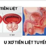 u xơ tuyến tiền liệt căn bệnh nam khoa này có nguy hiểm không