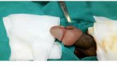 Dấu hiệu nhiễm trùng sau khi cắt bao quy đầu