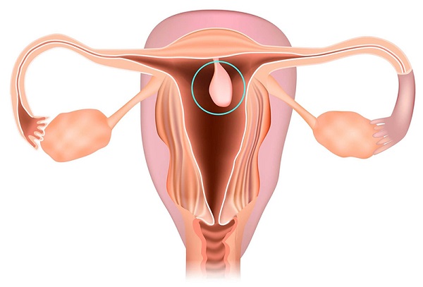 Polyp tử cung: Nguyên nhân, triệu chứng và cách điều trị hiệu quả nhất