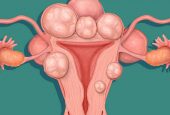 U Xơ tử cung – Bệnh phụ khoa không được coi thường ở nữ giới