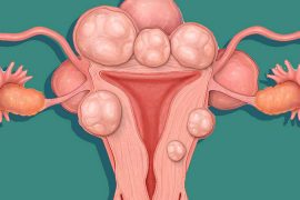 U Xơ tử cung – Bệnh phụ khoa không được coi thường ở nữ giới