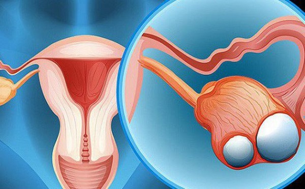 Bệnh u bì buồng trứng ở nữ giới – Điều trị tận gốc 100%