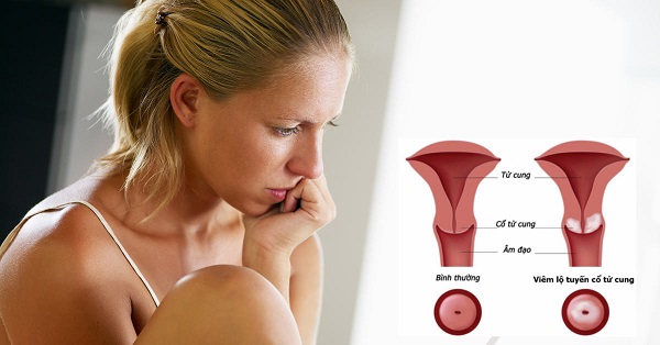 Viêm lộ tuyến cổ tử cung: Nguyên nhân và cách điều trị